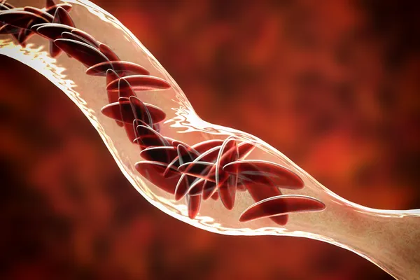 First Patient Begins Newly Approved Sickle Cell Gene Therapy