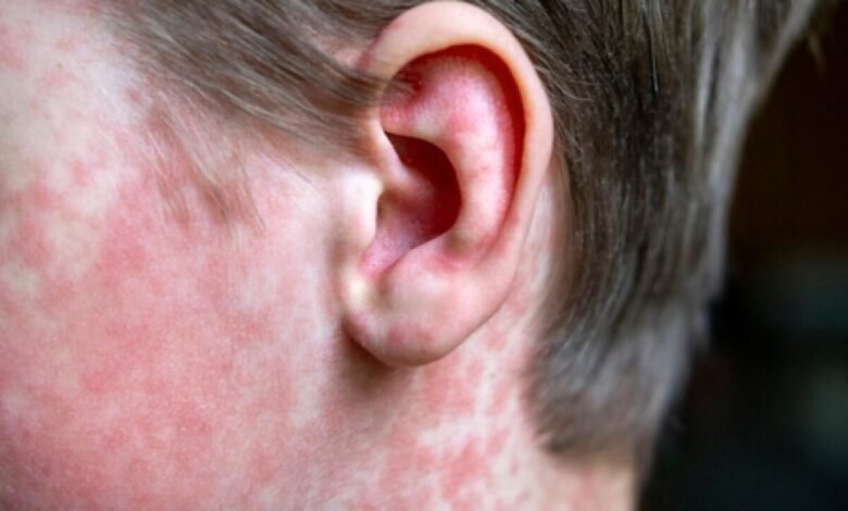 Kentucky measles outbreak 2026