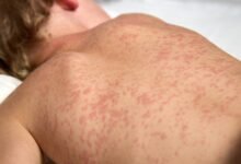 Bangladesh measles outbreak