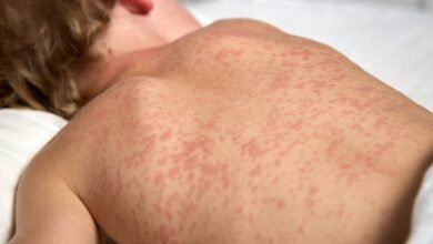 Bangladesh measles outbreak