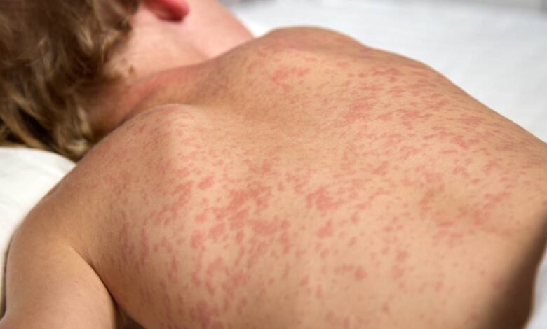Bangladesh measles outbreak